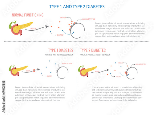Type 1 and type 2 diabetes, how it occurs.
Process from the pancreas to the uptake or not of insulin by the receptors.