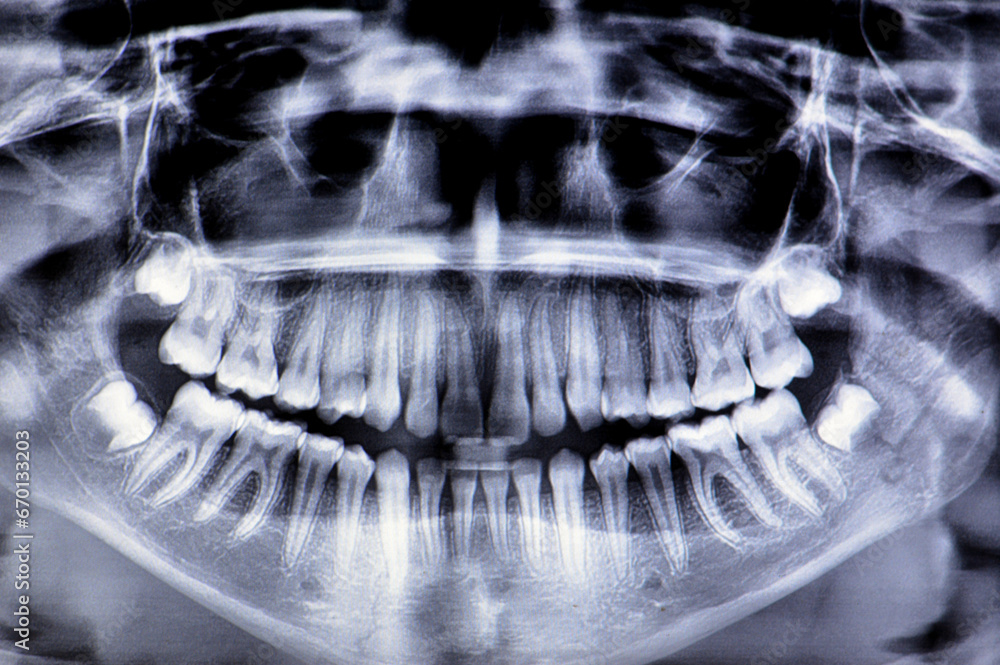 A panoramic radiograph of a girl fracture of the jawbone after a direct