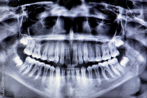 A panoramic radiograph of a girl fracture of the jawbone after a direct trauma to the left side, a panoramic scanning dental X-ray of the upper and lower jaw, shows a two-dimensional view