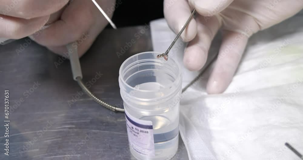 The doctor places the tissue sample taken during the endoscopic biopsy ...