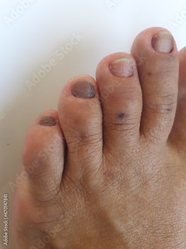 Unha do pé de pessoa com hipotireoidismo calosidades, micose, pele seca e desidratada © AndreaAlessandra