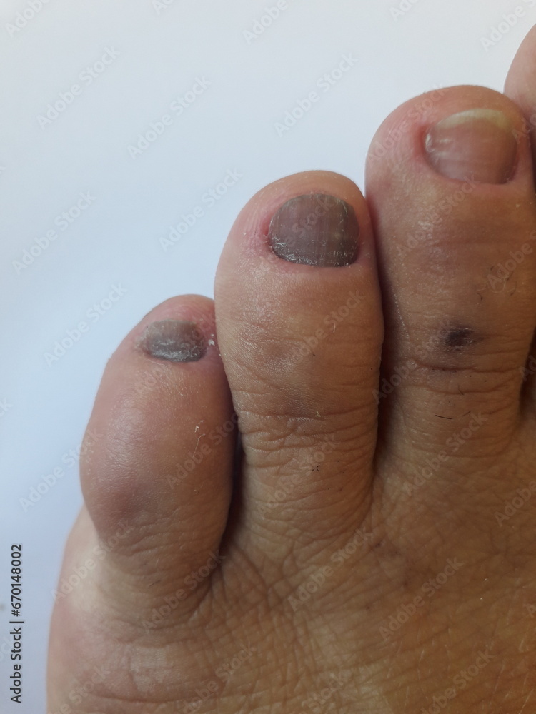 Unha do pé de pessoa com hipotireoidismo calosidades, micose, pele seca e desidratada Unha do pé de pessoa com hipotireoidismo calosidades, micose, pele seca e desidratada