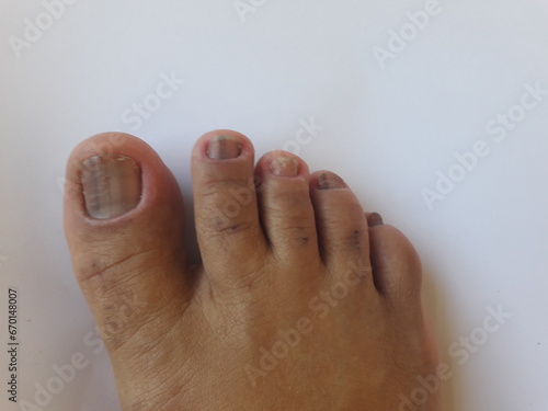 Unha do pé de pessoa com hipotireoidismo calosidades, micose, pele seca e desidratada photo