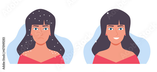 Sad woman with flake on head and shoulders and joyful woman without dandruff. Dry scalp problem. Disease of skin, health and scratching hair. Cartoon flat style isolated vector concept