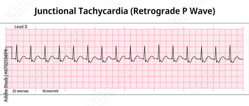 ECG Junctional Tachycardia - Retrograde P Wave - 8 Second ECG Paper - Electrocardiogram Vector Medical Illustration