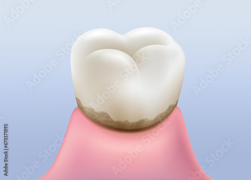 Unclean oral and dental hygiene This causes teeth to develop tartar, plaque and calculus. Dental hygiene concepts. Realistic vector illustration file.