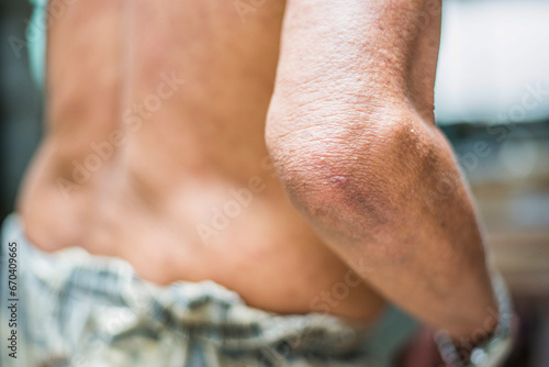Skin with rash problems in elderly people