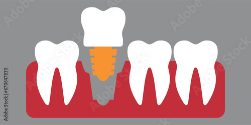 Implant icon. Vector on gray background