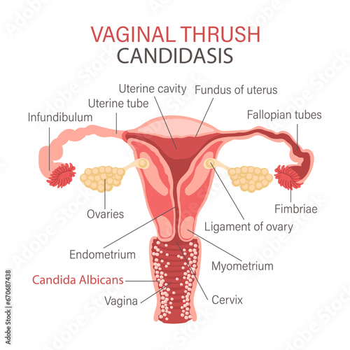 Vaginal fungal infection. Candidiasis. Infographics of gynecological diseases. Gynecology. Medicine. Infographic banner, vector.