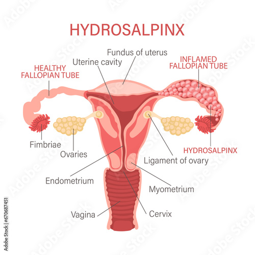 Hydrosalpinx. The fallopian tubes are blocked and filled with serous or clear fluid. Gynecology. Medicine. Infographics banner, vector. photo