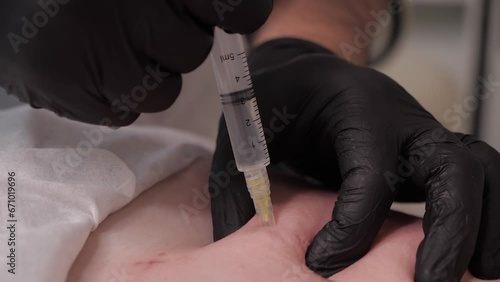 injection under the skin with a needle. close-up injections in the stomach. weight loss procedure. anti-aging procedures. doctor's hands in black gloves. syringe with a long needle. beauty.cosmetology photo