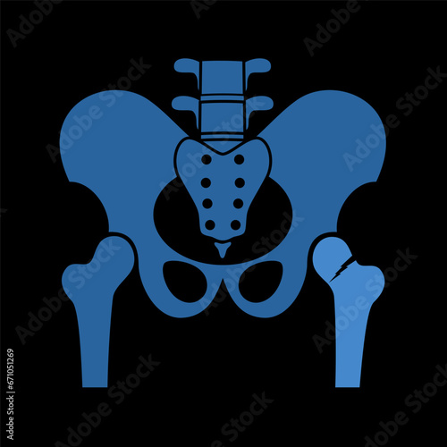 Hip bone fracture