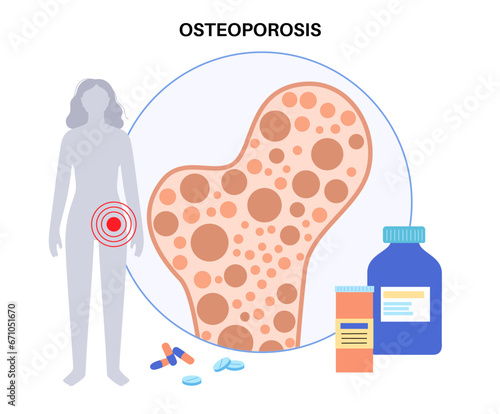 Osteoporosis medical poster