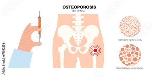 Osteoporosis medical poster