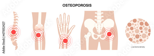 Osteoporosis medical poster