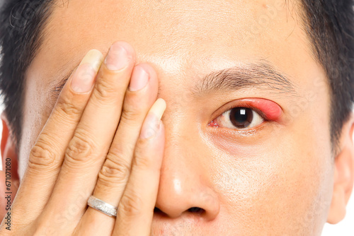 Portrait closeup of young Asian man with brown eyes with stye infection. eyelid abscess. eyelid infection. photo