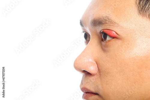 Portrait closeup of young Asian man with brown eyes with stye infection. eyelid abscess. eyelid infection. photo