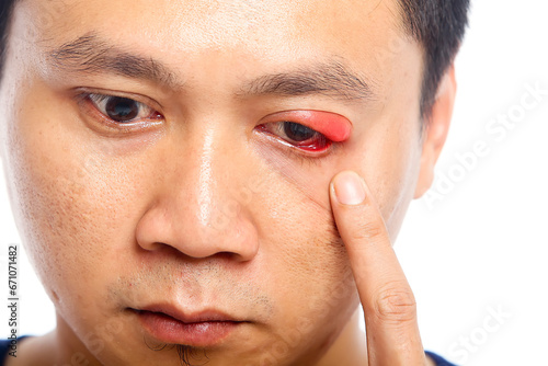 Portrait closeup of young Asian man with brown eyes with stye infection. eyelid abscess. eyelid infection.