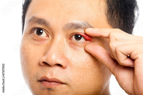 Portrait closeup of young Asian man with brown eyes with stye infection. eyelid abscess. eyelid infection.