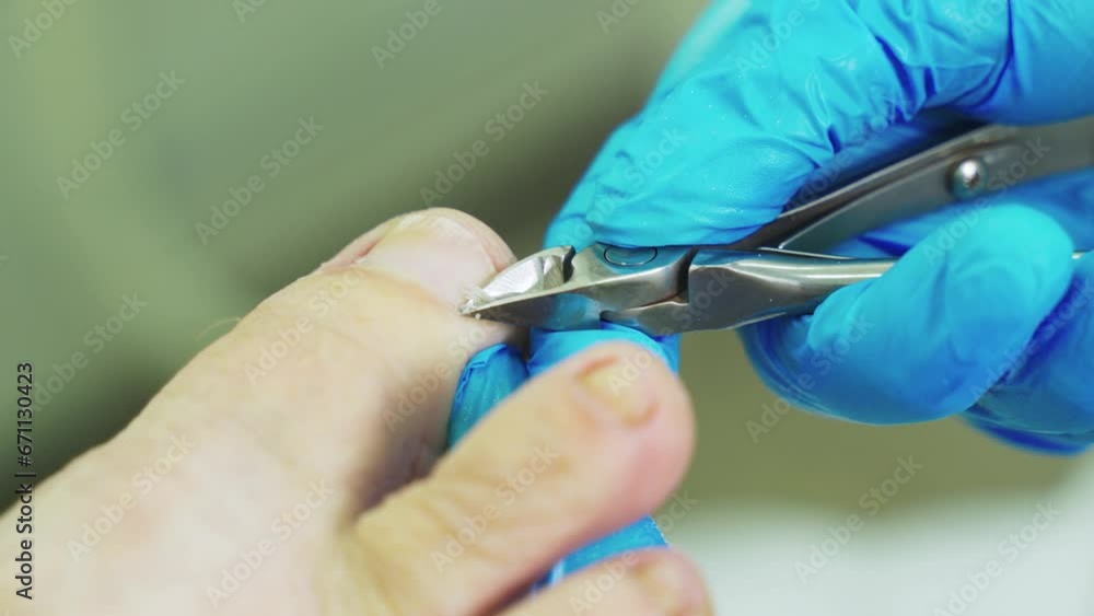 An orthopedic doctor in blue gloves removes dead skin tissue from the nail plate. Close-up. An orthopedic doctor in blue gloves removes dead skin tissue from the nail plate. Close-up.