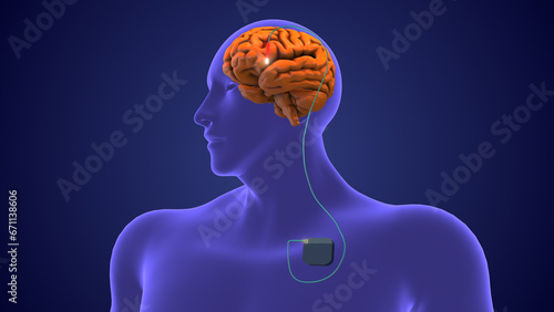 Deep brain stimulation medical concept	
