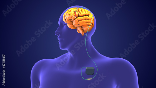 Deep brain stimulation medical concept	
 photo