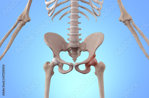Skeleton with osteoarthritis hip joint injury