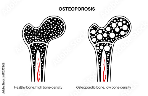 Osteoporosis medical poster photo