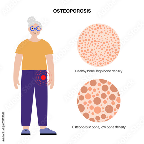 Osteoporosis medical poster