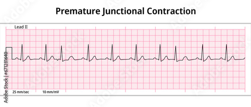 ECG Premature Junctional Contraction - 8 Second ECG Paper - Electrocardiogram Vector Medical Illustration