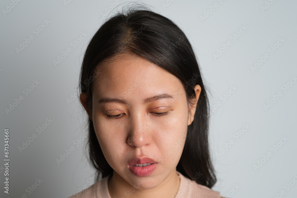 Asian woman with ongoing upper blepharoplasty surgery concept. Medical double eyelid plastic surgery, facing down feeling sad showing bruises on the eyelids. On white background blank copyspace. Asian woman with ongoing upper blepharoplasty surgery concept. Medical double eyelid plastic surgery, facing down feeling sad showing bruises on the eyelids. On white background blank copyspace.