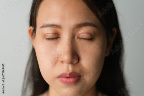 Asian woman with ongoing upper blepharoplasty surgery concept. Medical double eyelid plastic surgery, front view face closing eyes showing stitches and bruises on the eyelids. On white background.
