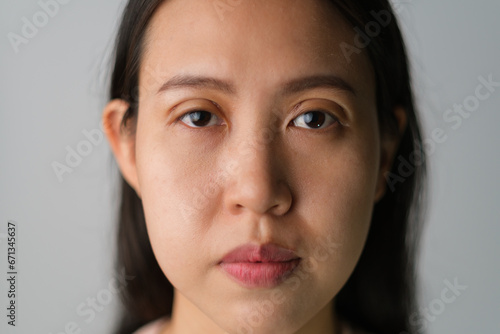 Asian woman with ongoing upper blepharoplasty surgery concept. Medical double eyelid plastic surgery, front view face showing bruises on the eyelids. On white background.