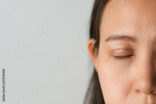 Asian woman with upper blepharoplasty surgery concept. Medical double eyelid plastic surgery, face view closing eyes with bruises and stitching on the eyelids. white background blank copyspace. photo