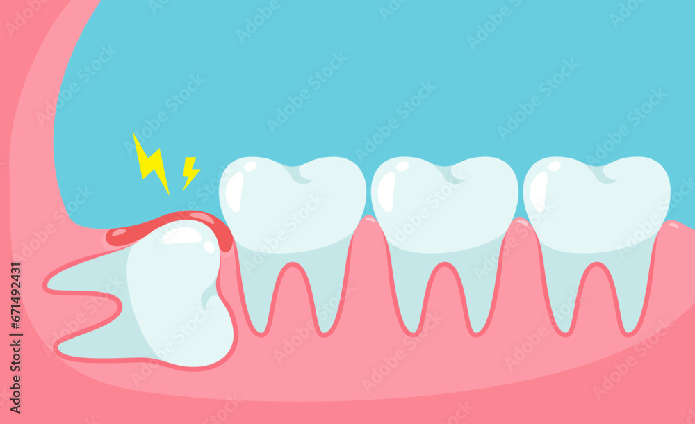 Impacted wisdom tooth cause pain in the mouth.Dental care concept Impacted wisdom tooth cause pain in the mouth.Dental care concept