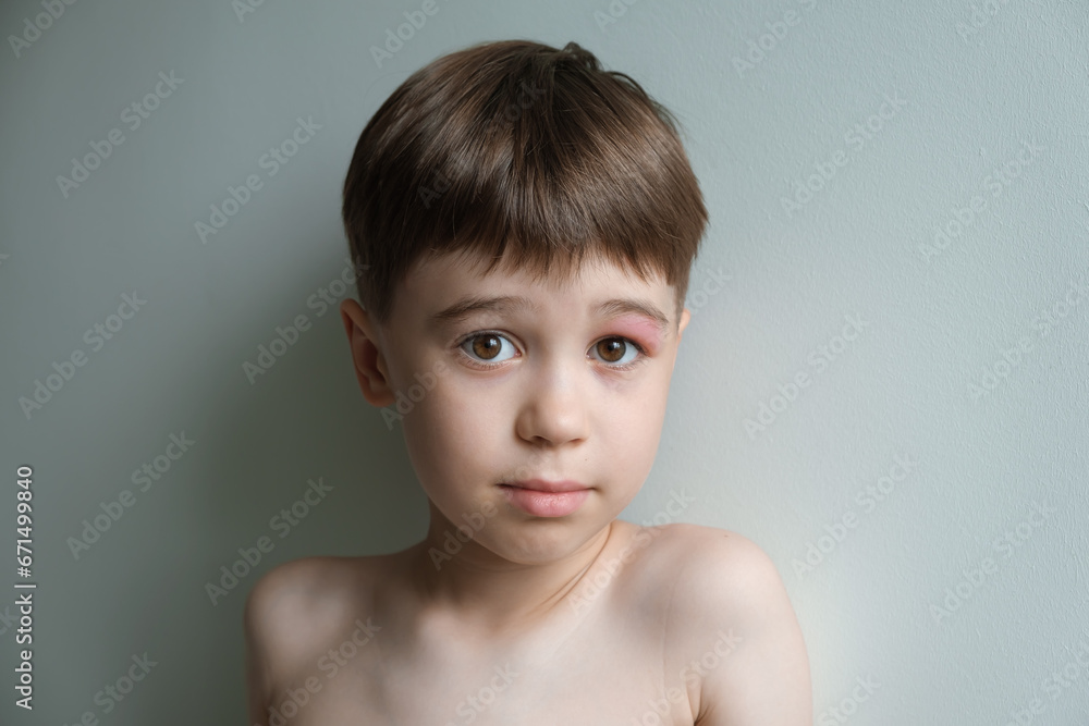 Portrait of little boy looking at the camera with a swollen eye from an insect bite close-up. Angioedema. Allergic response. Red inflamed upper eyelid. Disease or inflammation skin. Bee bite Portrait of little boy looking at the camera with a swollen eye from an insect bite close-up. Angioedema. Allergic response. Red inflamed upper eyelid. Disease or inflammation skin. Bee bite