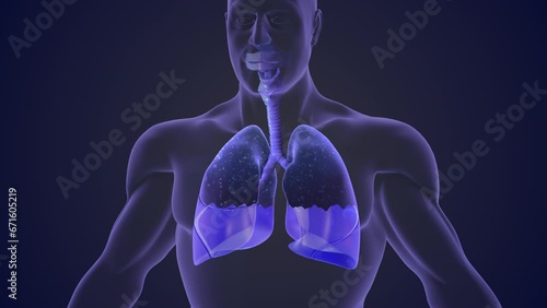 Pleural effusion represents inadequate disposal photo