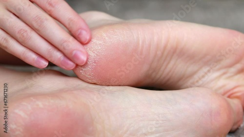 Close-up Dry skin of heels with cracks on feet