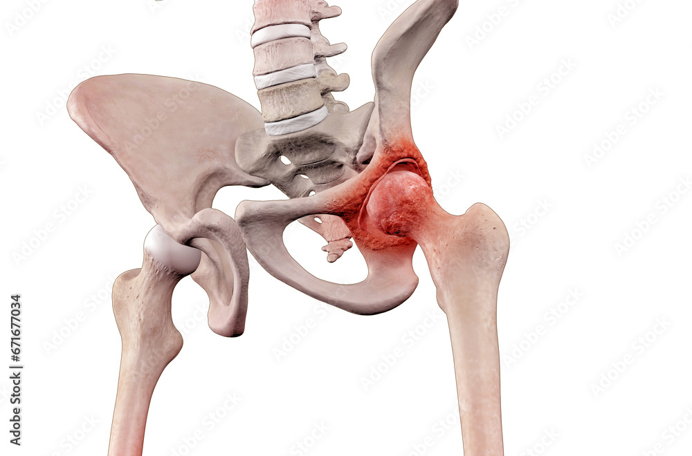 Skeleton with osteoarthritis hip joint injury - obrazy, fototapety, plakaty 