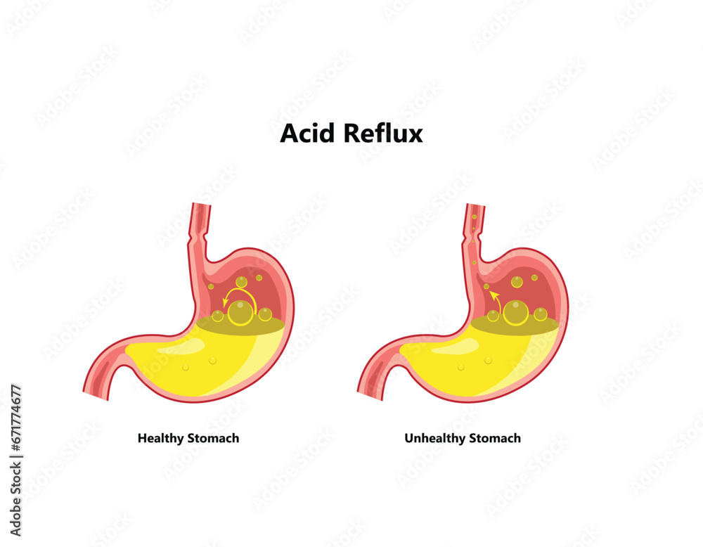 Reflux or gastroesophageal reflux, Heartburn. Stomach disease, stomach problem disease concept. Vector drawing