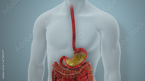 Acid Reflux GERD Disease Illustration