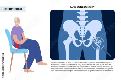 Osteoporosis medical poster