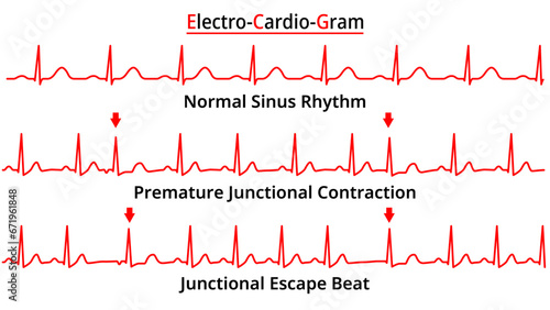 Set of ECG Common Abnormalities - Junctional Escape Beat - Premature Junctional Contraction PJC - Electrocardiogram Vector Medical Illustration