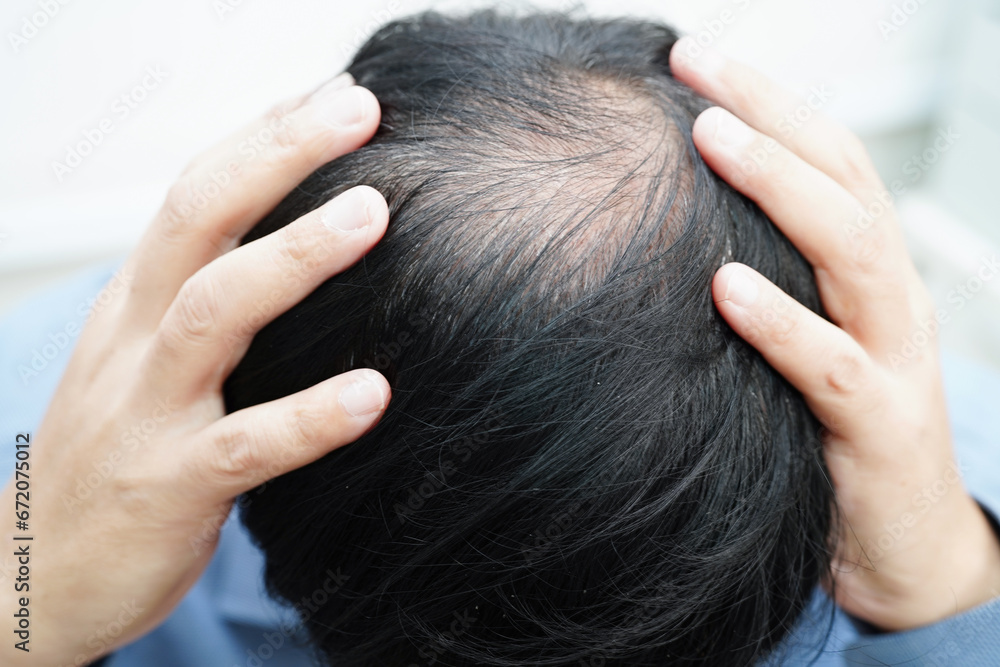 Bald head in man, hair loss treatment health problem. Bald head in man, hair loss treatment health problem.