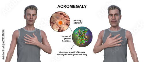 Acromegaly, 3D illustration photo