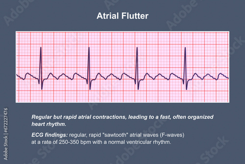 Canvas Print ECG in atrial flutter, an abnormal heart rhythm characterized by rapid, regular