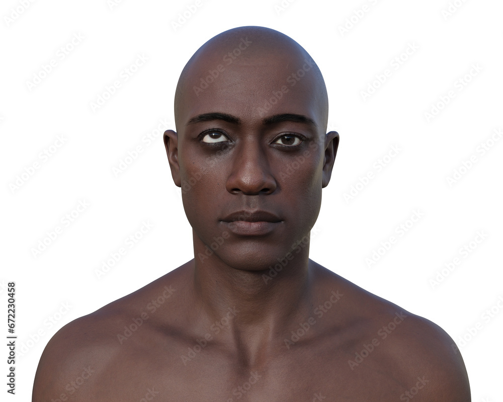 A man with hypertropia, 3D illustration