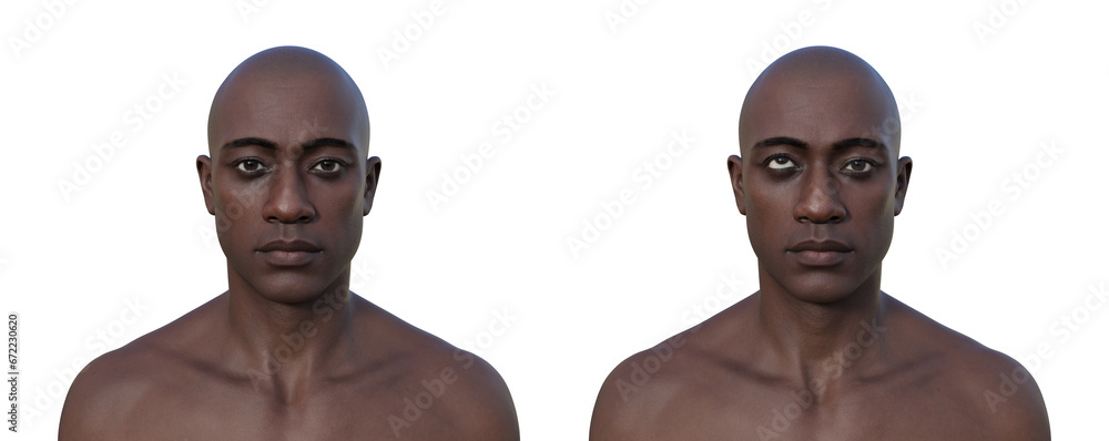 A man with hypertropia and a healthy man, 3D illustration - obrazy, fototapety, plakaty 