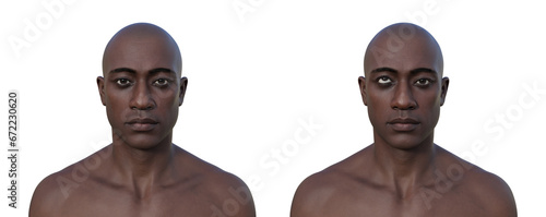A man with hypertropia and a healthy man, 3D illustration photo