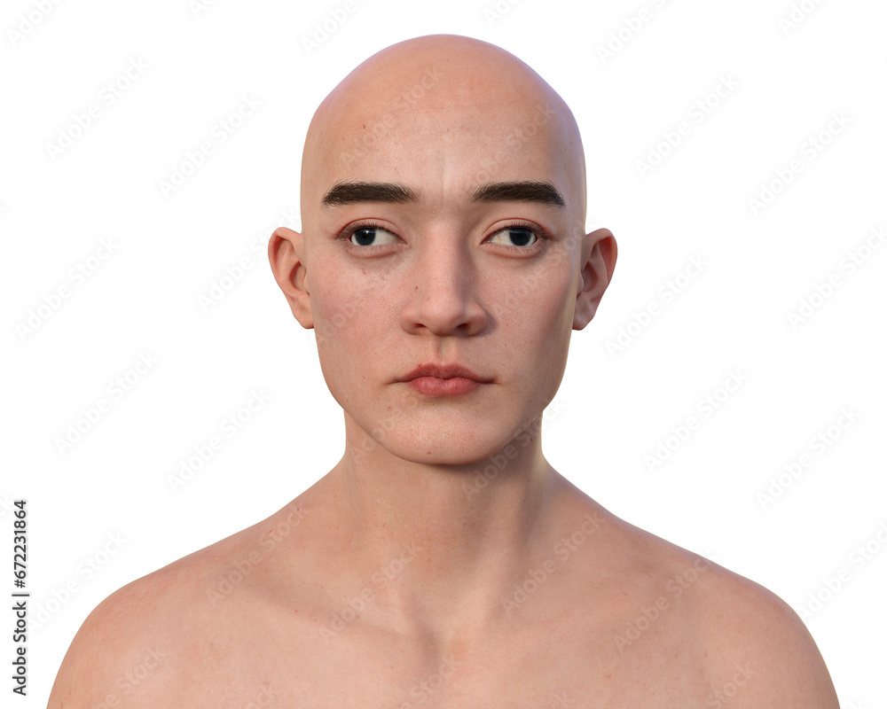 Fototapeta premium A man with exotropia, 3D illustration